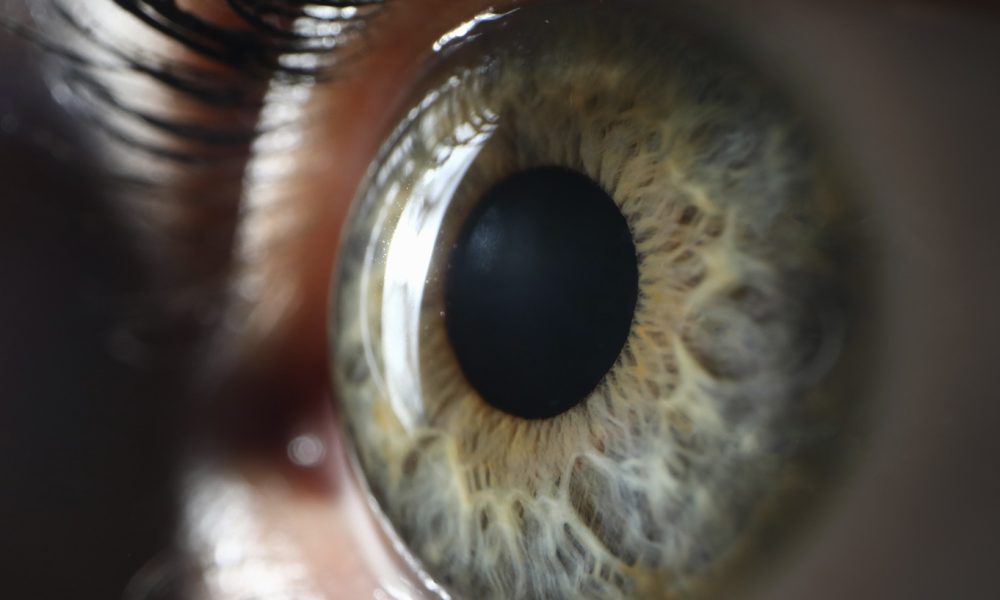 Foto: KERATOCONUS