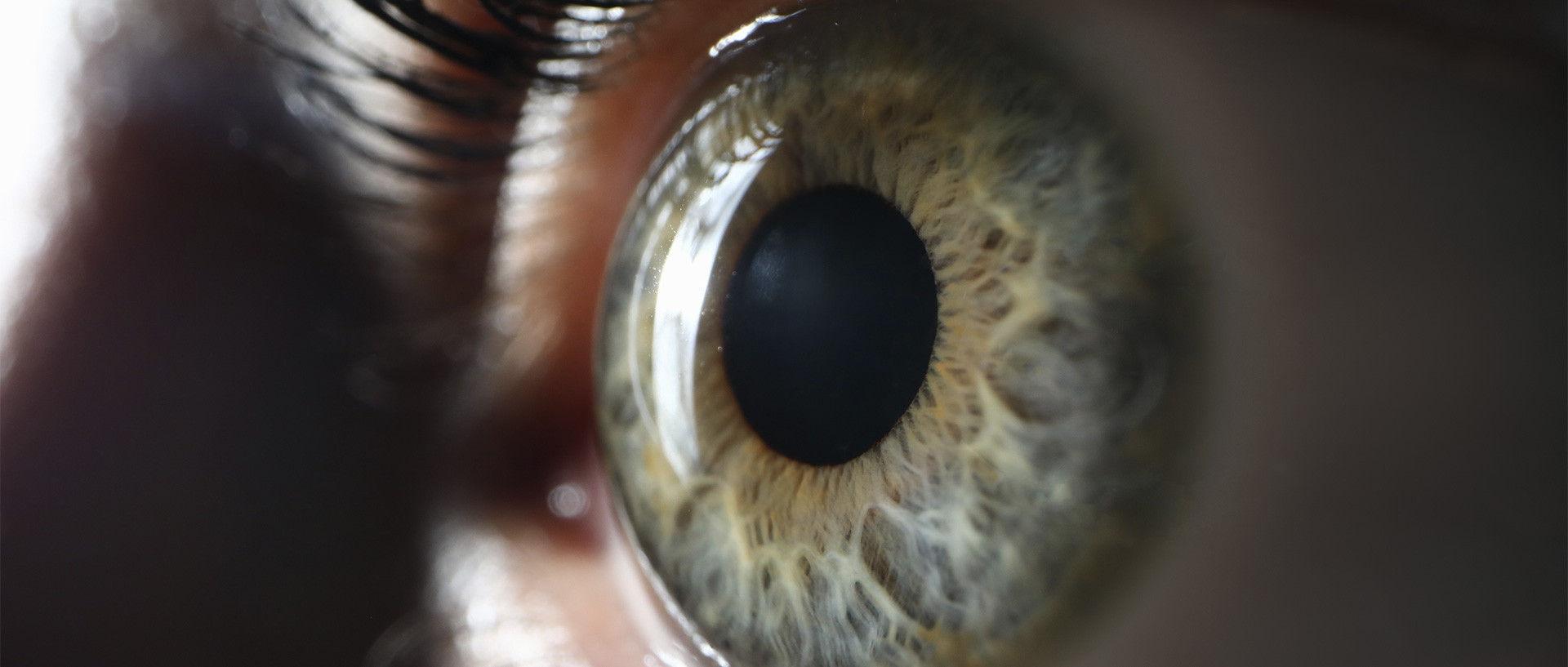 Imagem: KERATOCONUS