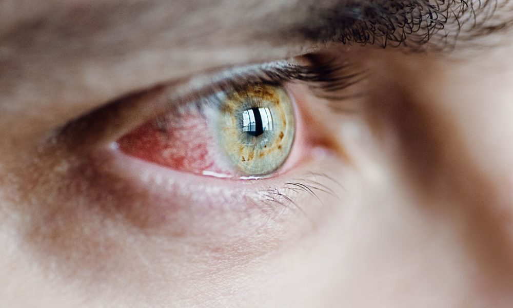 Foto: DRY EYE