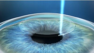 Imagem: Cirurgia de correção de grau com alta tecnologia